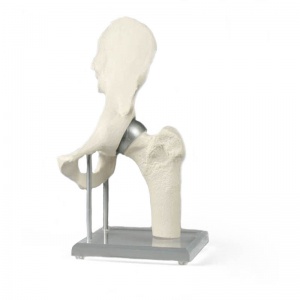 Hip Joint Model with Resurfacing Implant